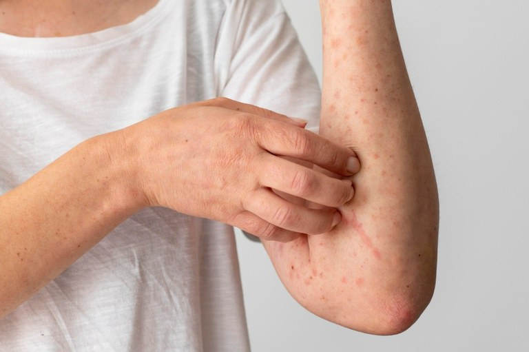 Adulto com alergia alimentar